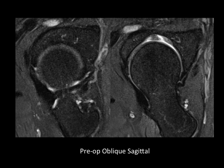 Figure 5 for case acetabular labrum ( RID2644 )